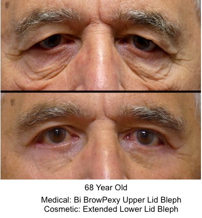 NEIGELCENTERPA's tweet image. #heavy #drooping #upper #eyelids #DrNeigel #performed #medical #bibrowpexy &amp;amp; #cosmetic #extended #lower #blepharoplasty #results #thrilled