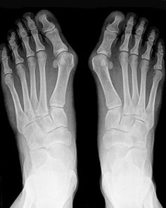 Hallux valgus - was hilft?
bit.ly/1SQ93RL