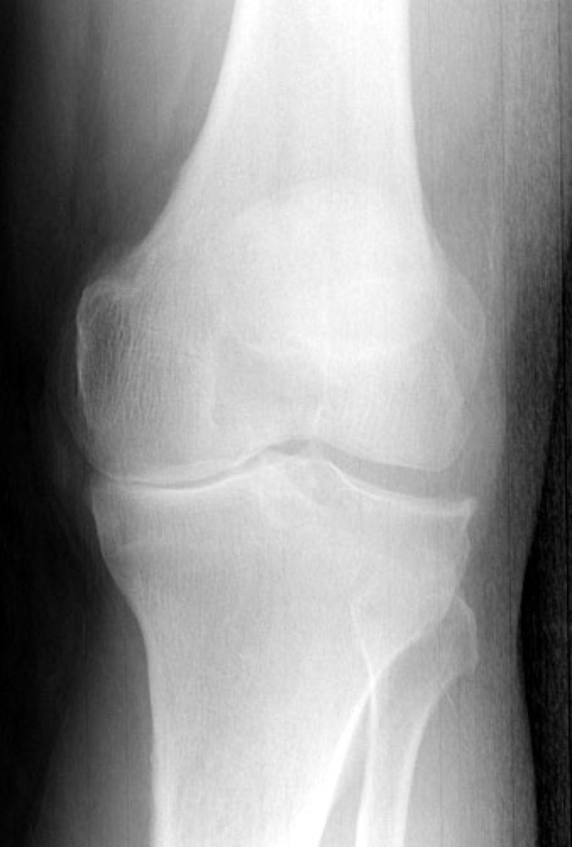 Артроз коленного сустава мениск. Феморопателлярный артроз. Мениск коленного сустава рентген. Гонартроз коленного сустава рентген. Гонартроз коленного сустава 3 степени снимки.