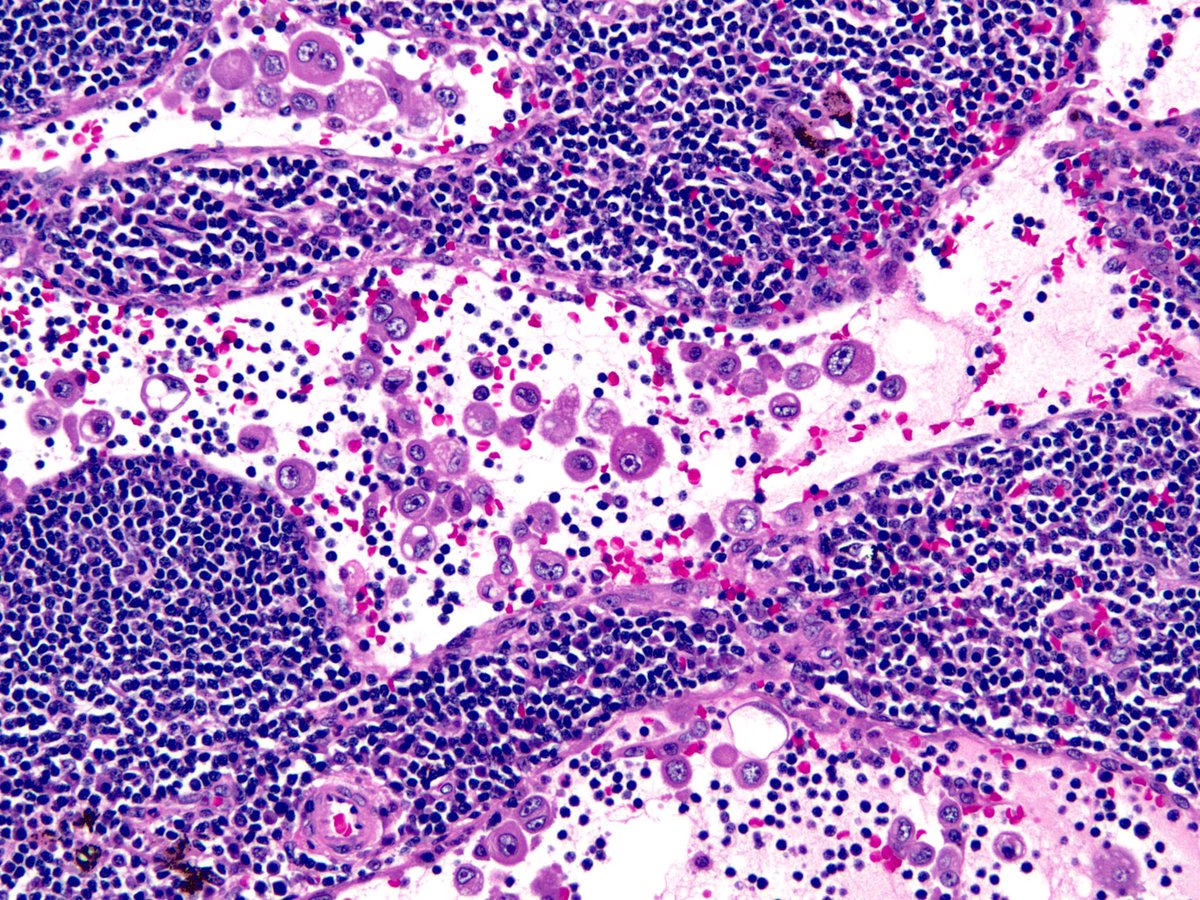 smlungpathguy's tweet photo. Lymph node mets. Can you guess the primary? #pathology @mvmd0908 @pembeoltulu @Missle https://t.co/7mOSPQiI3A