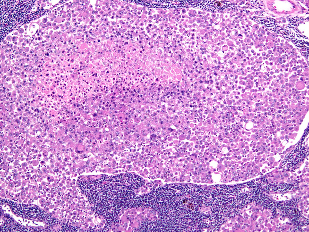 smlungpathguy's tweet photo. Lymph node mets. Can you guess the primary? #pathology @mvmd0908 @pembeoltulu @Missle https://t.co/7mOSPQiI3A
