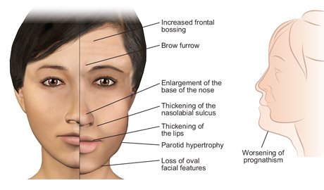 acromegaly pituitary gland hormone features disorders tumor acromegalia diagnosis endocrine bossing overgrowth maxillary hgh mandibular carney affects