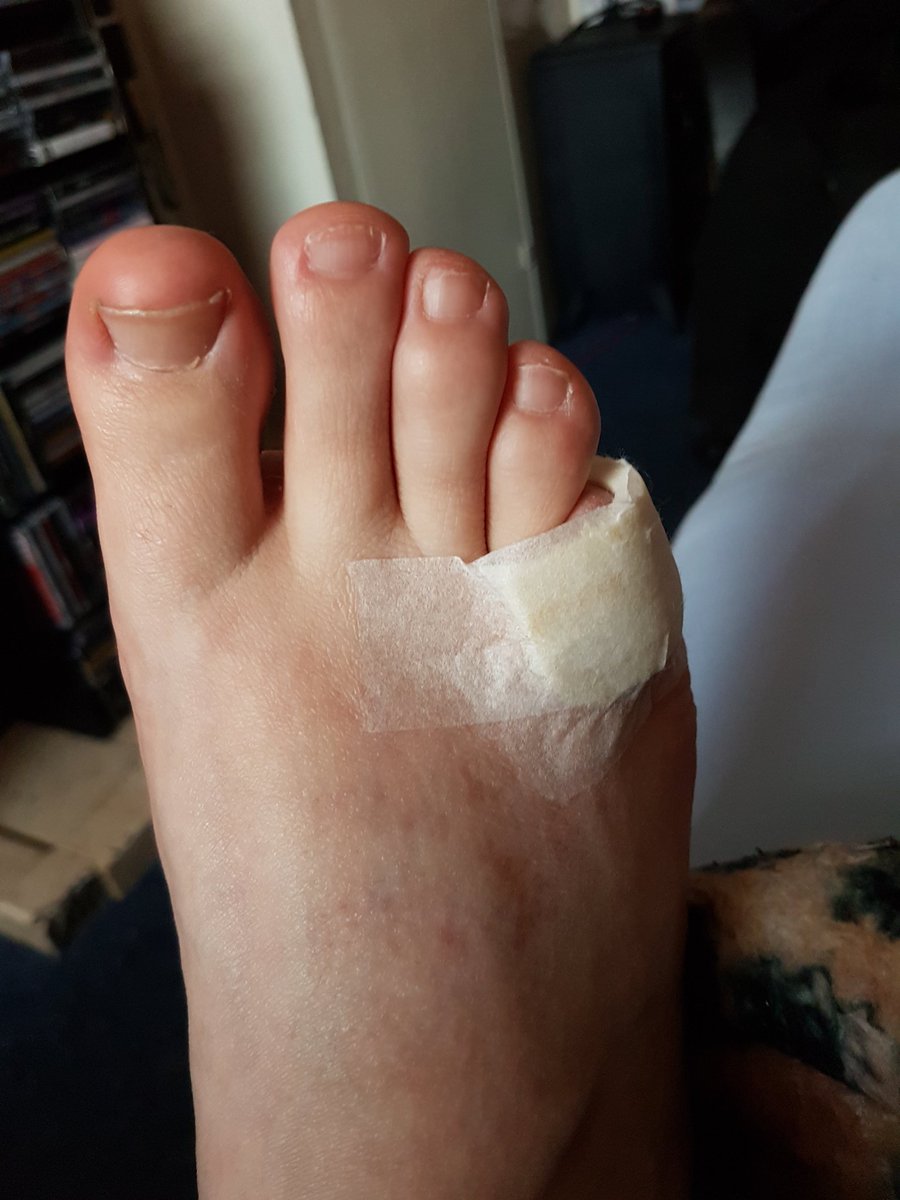 My infection toe