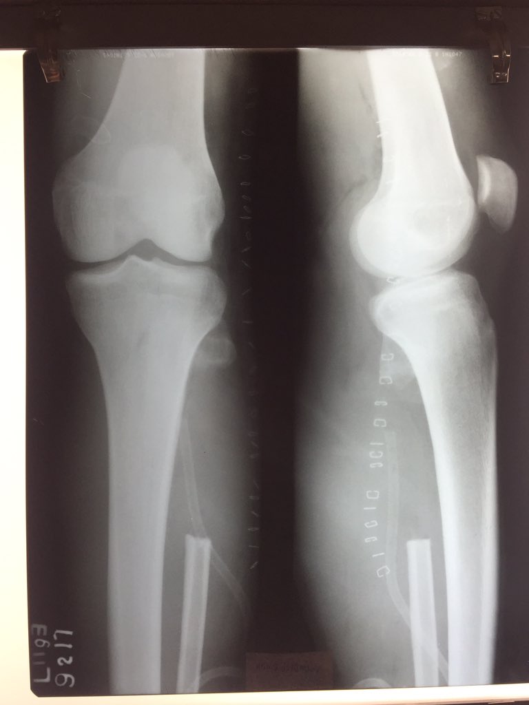drmanojkrortho1's tweet photo. Type 1 #fibular #excision done for previous case https://t.co/xL7N4oA33e