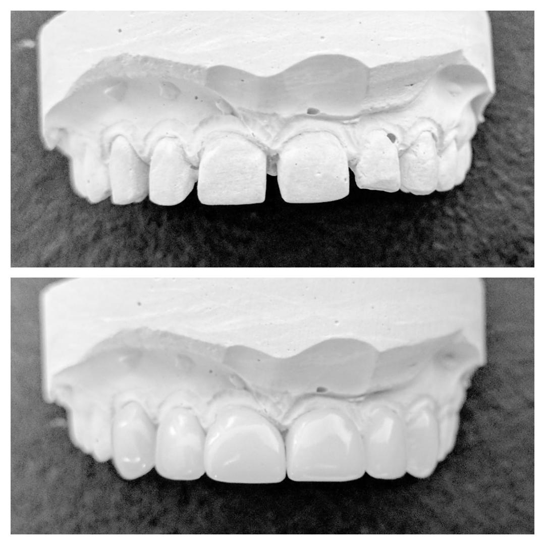ChrisC4mpbell's tweet photo. Unpreped veneers, diastemas closed. CAD Milled PMMA B1 @DentalLogicEdin using @IvoclarUK  materials https://t.co/jxLQRANZsz