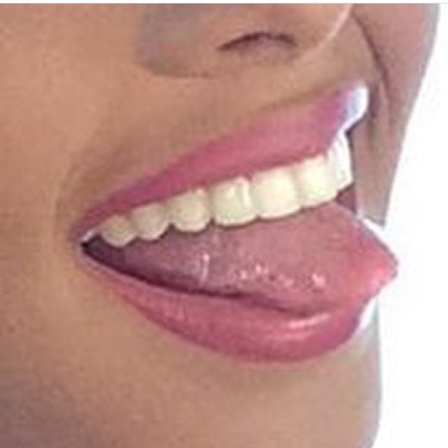 Tratamientos combinados logran una sonrisa perfecta 
Blanqueamiento y algunas carillas ! Sonrisa que enamora 😀😀#carillasdentales #odontologo