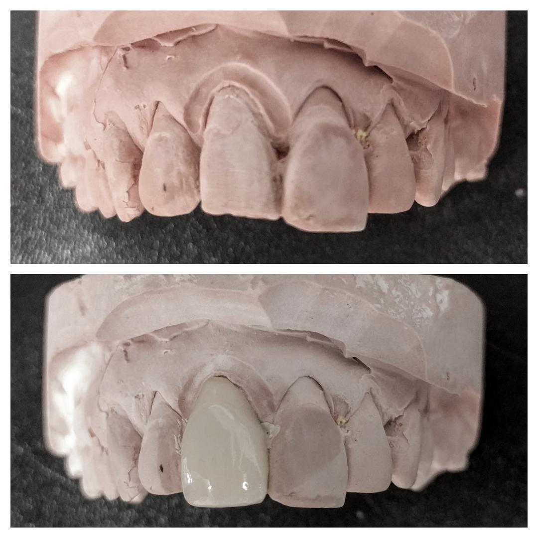 ChrisC4mpbell's tweet photo. E-Max veneer completed using @3Shape  software @IvoclarUK materials in the @DentalLogicEdin Lab https://t.co/80x8GpMOj5