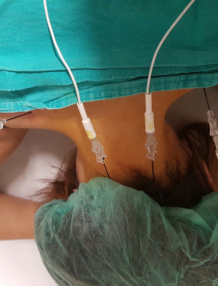 Başagrinizdan oksipital sinire uygulanan radyofrekans tedavisi ile kurtulabilirsiniz