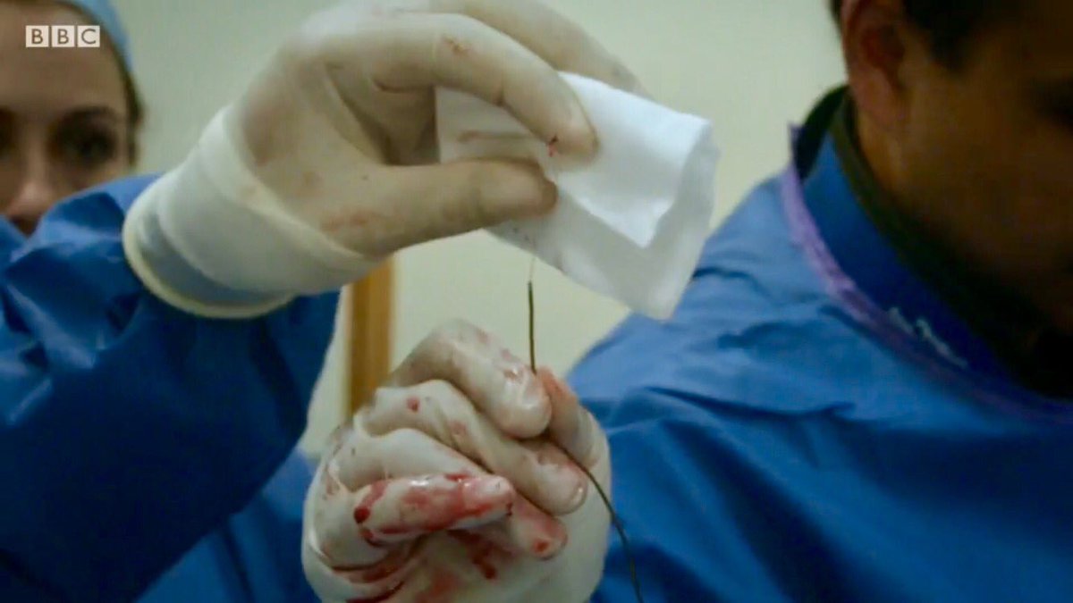 majakecman's tweet photo. Surgeon fishing out a blood clot from the brain. Unbelievable. #hospital @BBCTwo @ImperialNHS https://t.co/KpelbZzHz8