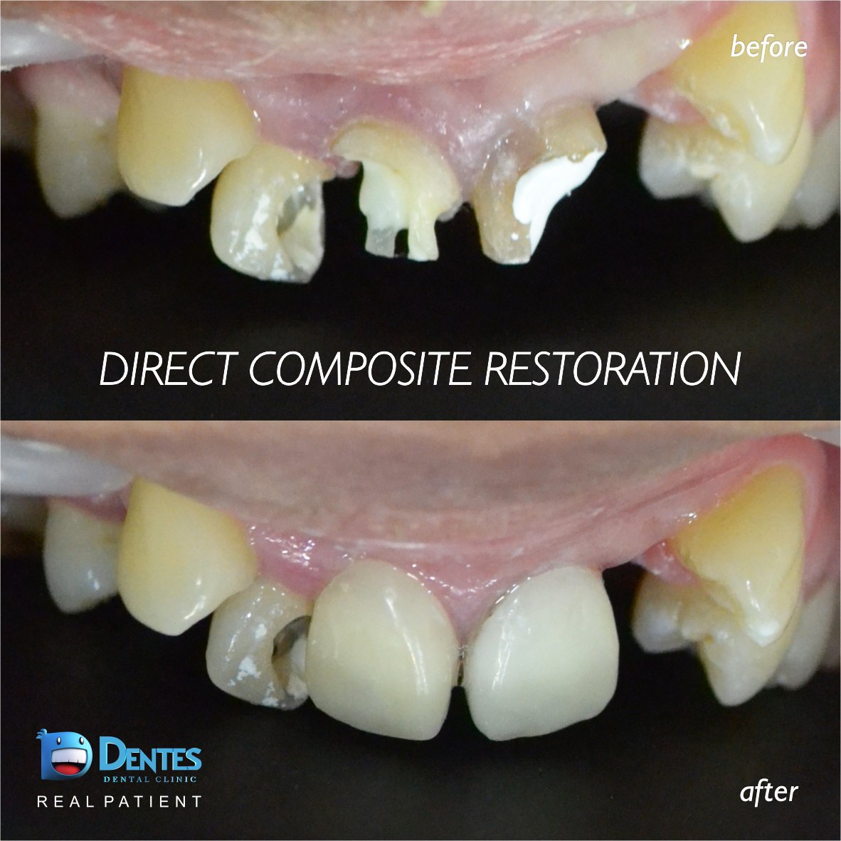 klinikdentes's tweet image. "Let us always meet each other with smile, for the smile is the beginning of love." 

- Mother Teresa
 #directcomposite #tambalgigi