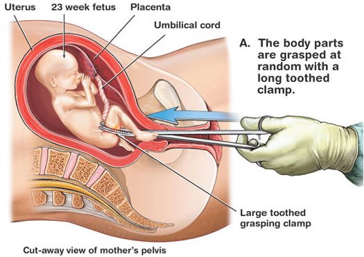 LifeNewsToo's tweet photo. Pennsylvania Senate Votes to Ban Dismemberment Abortions Tearing Babies Limb From Limb https://t.co/SabkFbZwho https://t.co/BPtU9rVibY