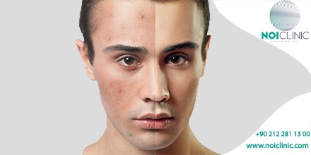 #PRP kişinin kendi kanından hazırlanan; kırışıklıklar, göz altı morlukları ve leke tedavisinde etkili rol oynayan bir uygulamadır.