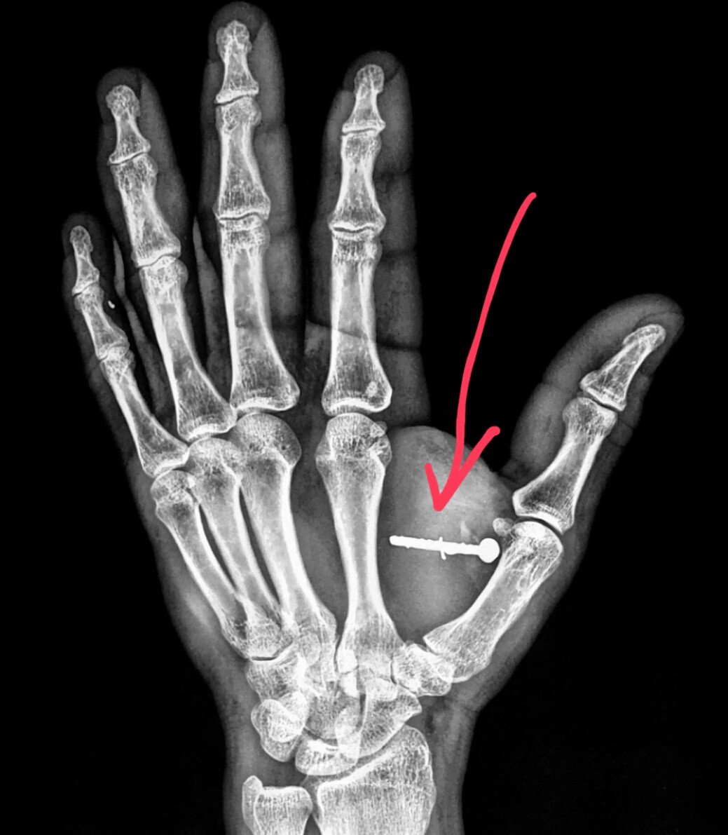 Injured By Staple Gun