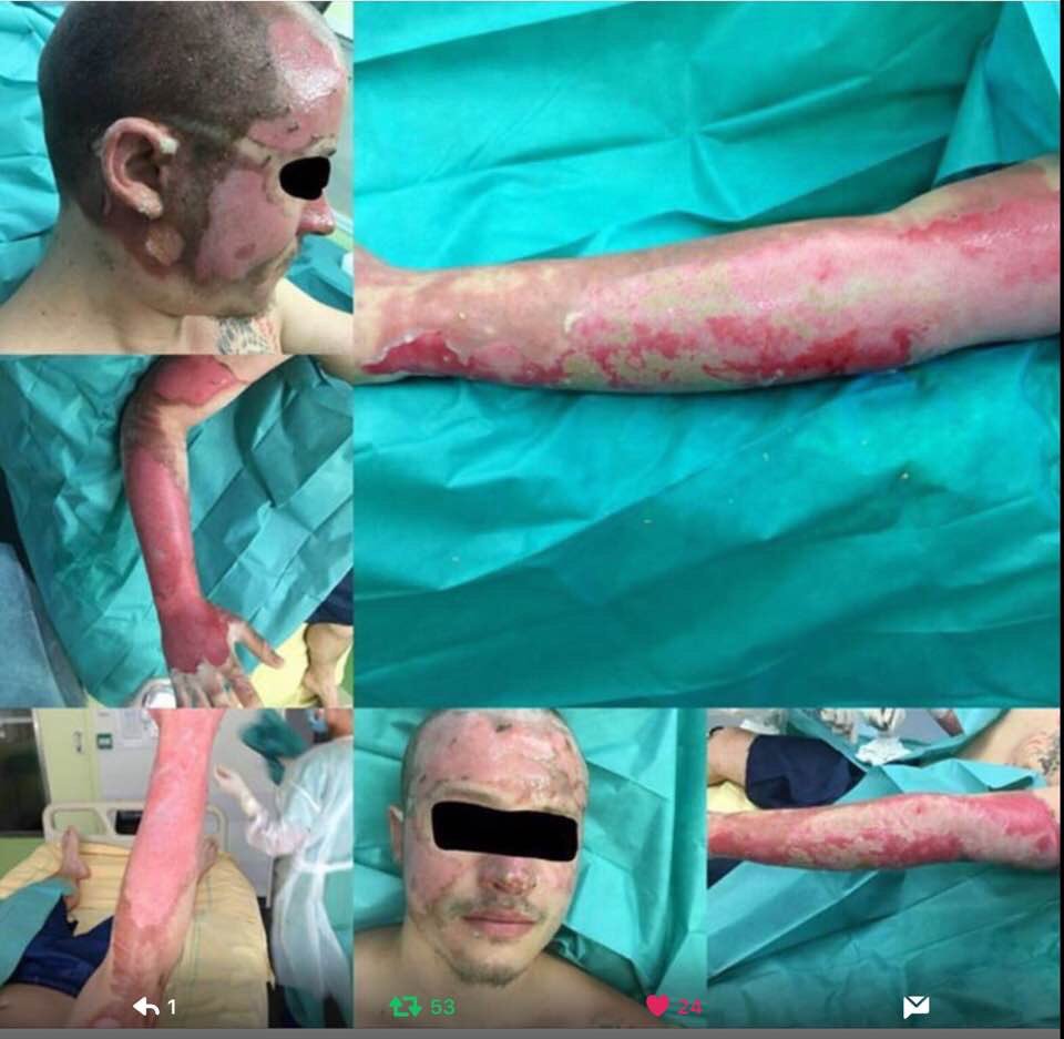 DeborahBonjour's tweet photo. Visite de #Théo c'est fait et tant mieux mais @fhollande ce policier brûlé vif qui n'a reçu ni message, ni visite de votre part, pourquoi? https://t.co/SHH7VEXkD5