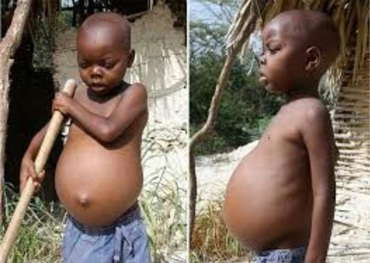 here are some more pictures of Kwashiorkor. this happens when there is not enough protein in your diet!