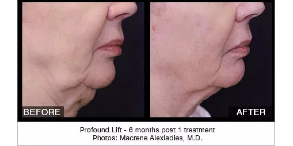 ProfoundLift's tweet image. Profound™ patients experience amazing results &amp;amp; are not afraid to share them: bit.ly/2dfFwPG