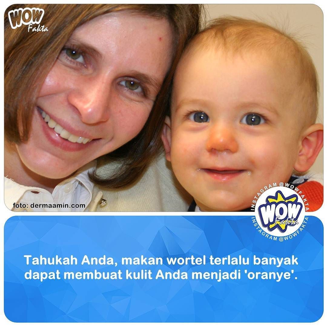 ift.tt/2kYXbkS [#wowfakta] Dilansir dari Huffington Post, ini adalah kondisi medis yang bernama 'carotenem…