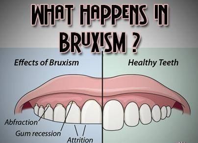 DrBalbir's tweet photo. Regular, persistent teeth grinding can cause jaw pain and discomfort and wear down your #teeth. https://t.co/dmLMPShtqh