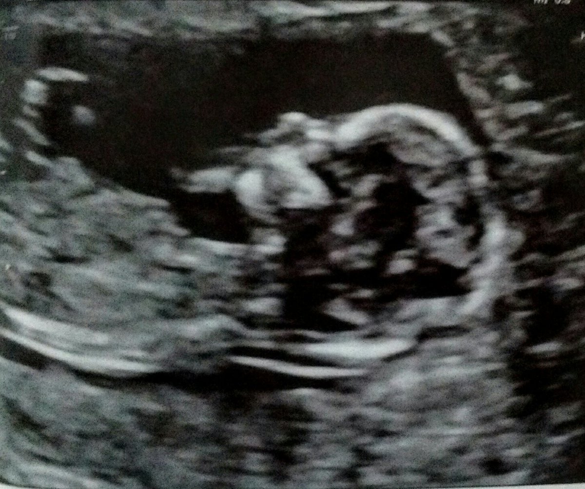 pourandbeerded's tweet photo. Kind of hard to see but thats my little brewing helper. Can't wait to meet her. #womenbrewers #Craftbeer #daddyslittlegirl #beerdaddy https://t.co/VWDEjyYbCG