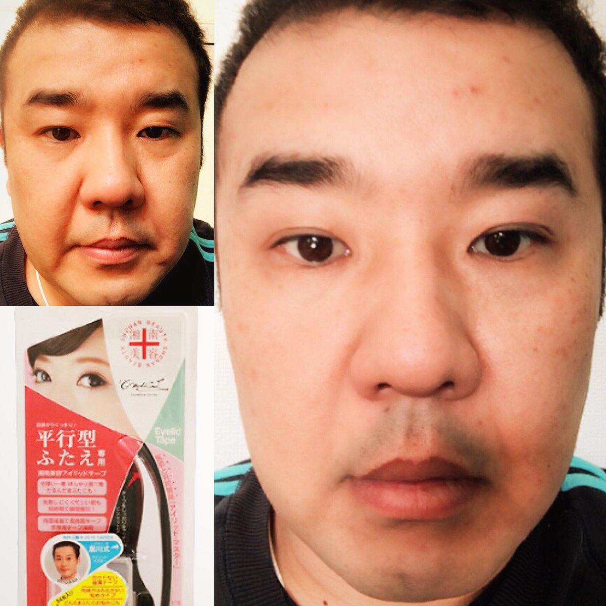 川出康介 Twitter પર インパルス堤下さんが 湘南美容アイリッドテープ を使って ナチュラルな二重になって下さいました 初めて使ったとは思えないほどの綺麗な仕上がりでした 湘南美容 アイリッドテープ 湘南美容外科 インパルス 堤下さん 二重テープ