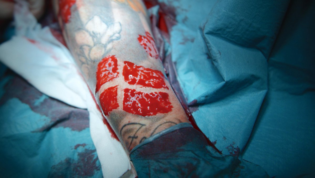 novonordiskfond's tweet photo. Rødt og sort blæk er årsag til at flere og flere tatoverede må hospitalsbehandles #dksund #dkforsk #tattooing https://t.co/UopttDJIS3 https://t.co/5Ra1JHu7lJ
