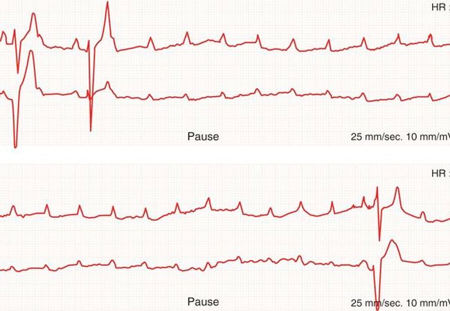 Surprises emerge from largest-ever study of late atrioventricular conduction recovery cle.clinic/2fqL3q6