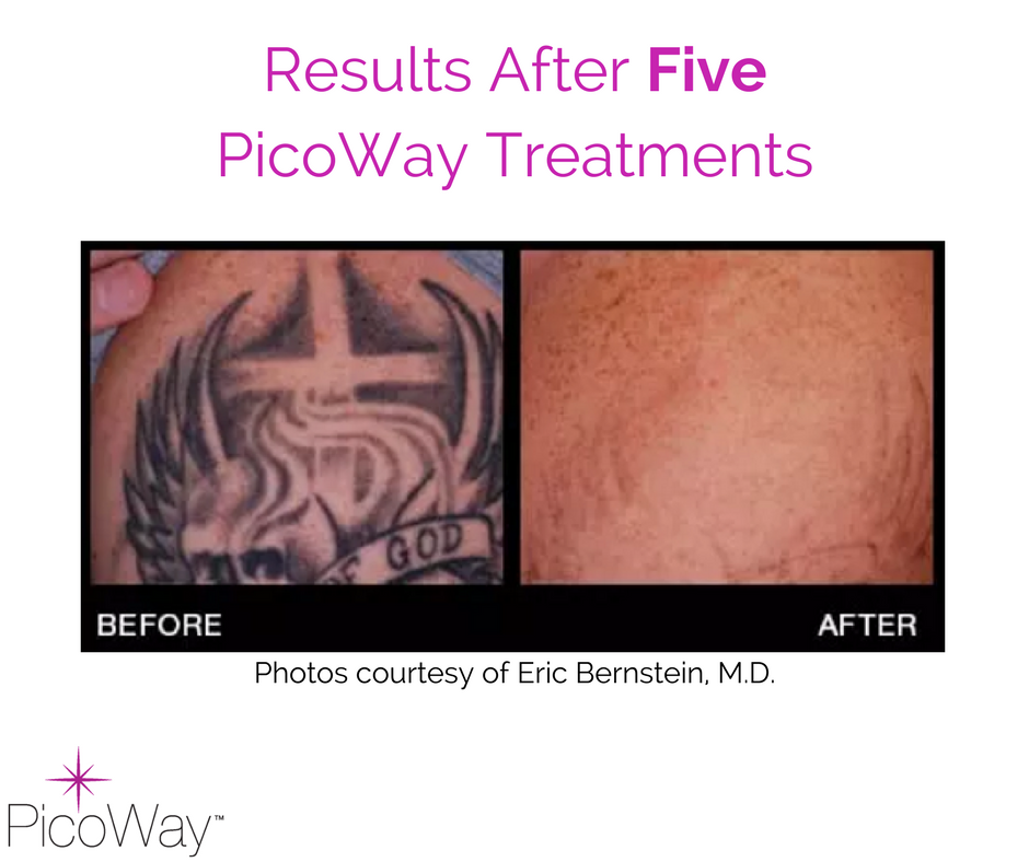 PicoWay® results speak for themselves. After only a few treatments, patients experience real results that they can see!