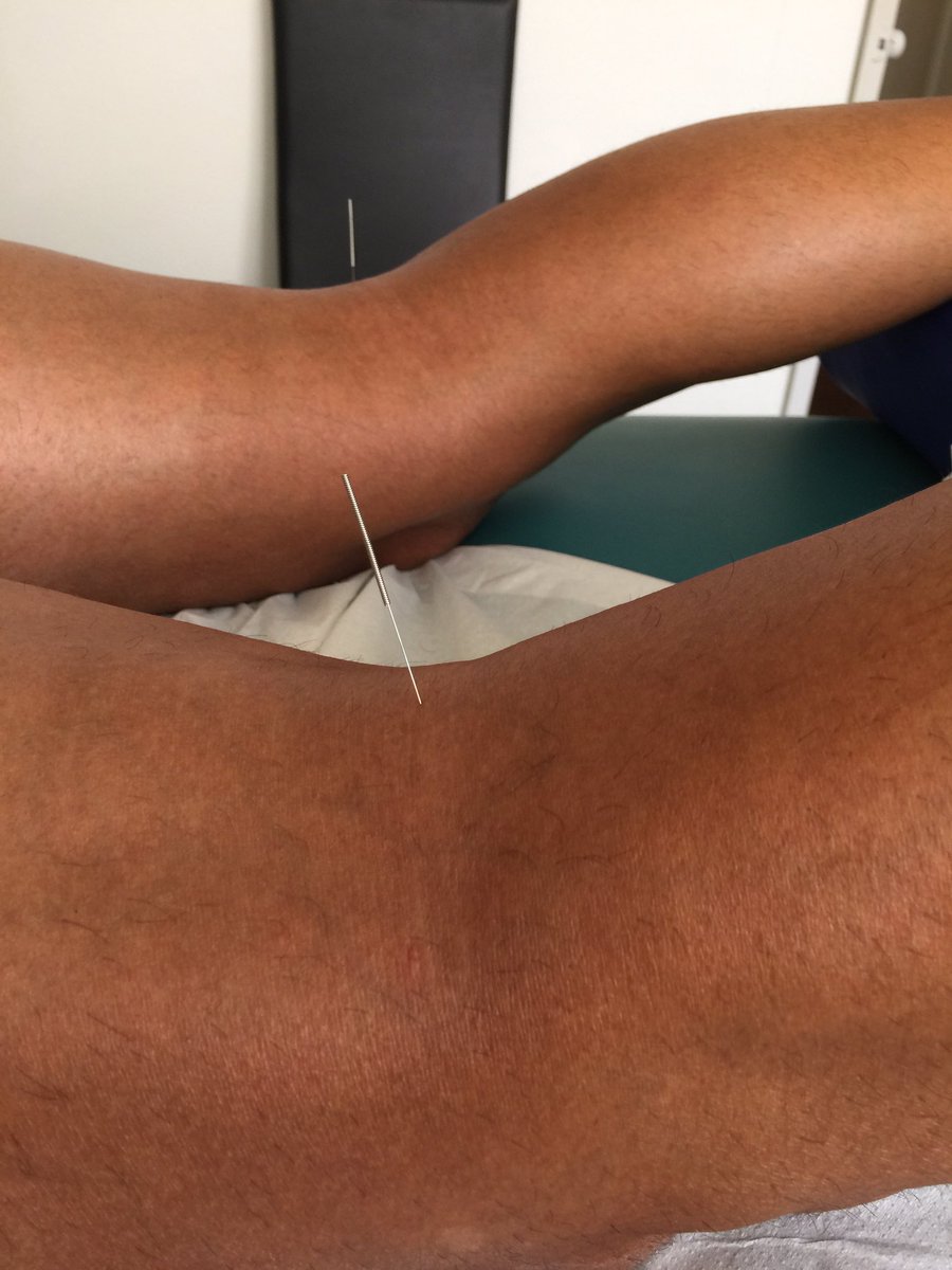 demech_salud's tweet photo. Tratamiento dolor lumbar (triatleta) con masaje, acupuntura (V40) y Moxa. https://t.co/37tOTylozX