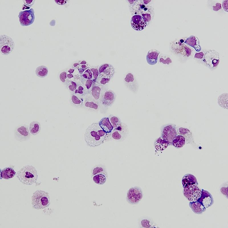 DFBC_PedCare's tweet photo. A nice science workaround & new hope for Diamond Blackfan anemia: https://t.co/h5m2OWWFld #cureDBA #stemcells https://t.co/GxvxFAPA8b
