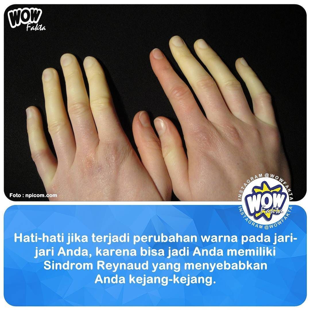 ift.tt/2l35g8f [#wowfakta] Jika Anda melihat bahwa jari-jari Anda sering berubah warna, Anda harus mewaspa…
