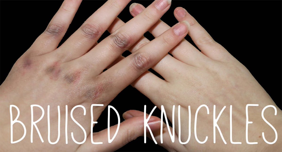 nobodyproblems's tweet photo. Bruised Knuckle: Causes and How to Treat Them
https://t.co/1BeDcx0y35
#Bruised_Knuckle #Natural_Treatments #skincare https://t.co/s6j0lhhpU5