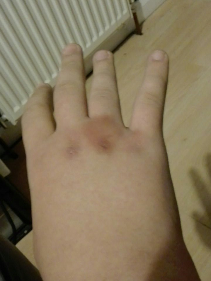 JakeElsey2's tweet photo. 12 hour shift with a potentially broken knuckle 😂 Whats even the point XD https://t.co/L0G0PCQLji