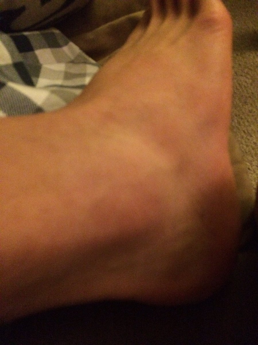 JezrellCunanan's tweet photo. Another bad luck day😢#brokeankle https://t.co/QJ3yZdGD9a