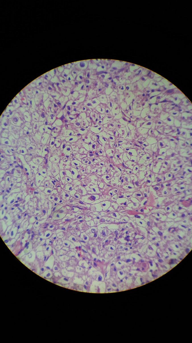 crazylymphocite's tweet photo. Hepatocarcinoma with clear cells. MRI: Alone lesion.  Inmmuno: CD10, PAX-8, vim, hepatocyte, CEA and EMA all -tive. https://t.co/LOcrW8LE9u