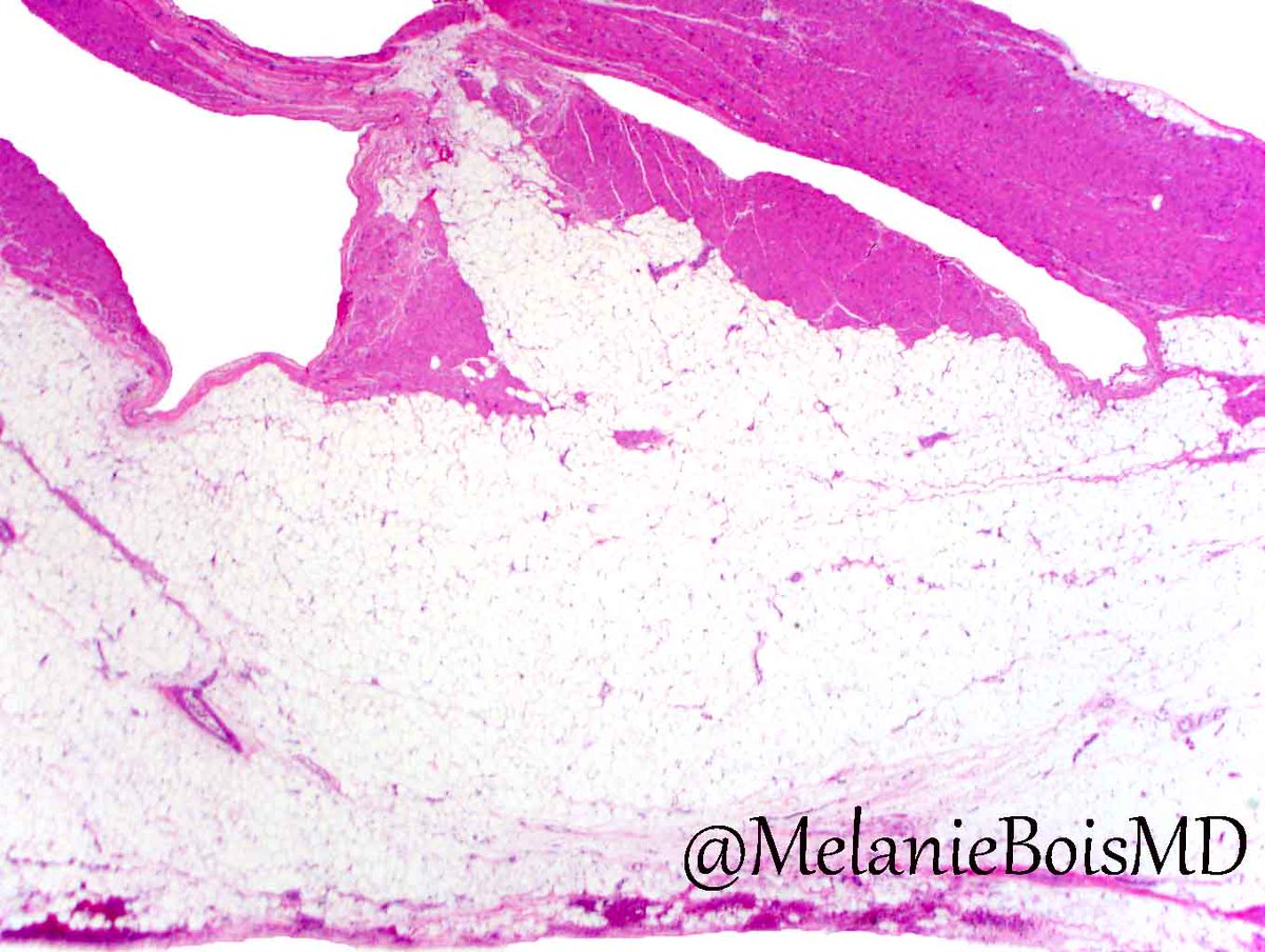 MelanieBoisMD's tweet photo. Arrhythmogenic Cardiomyopathy: Fibrofatty myocardial replacement & assoc w/ mutation in cardiac desmosomal proteins #MayoCVPath #CardiacPath https://t.co/Au9b3AC3ro