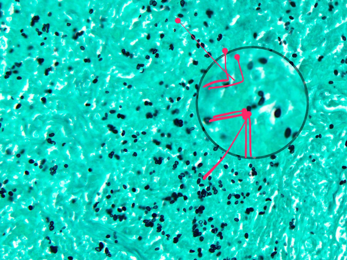 smlungpathguy's tweet image. Narrow-based budding in Histoplasma #pathology #pulmpath @AsoniDO @dr_abdulaleem @TimAllenMDJD @pembeoltulu (happens in Crypto too)
