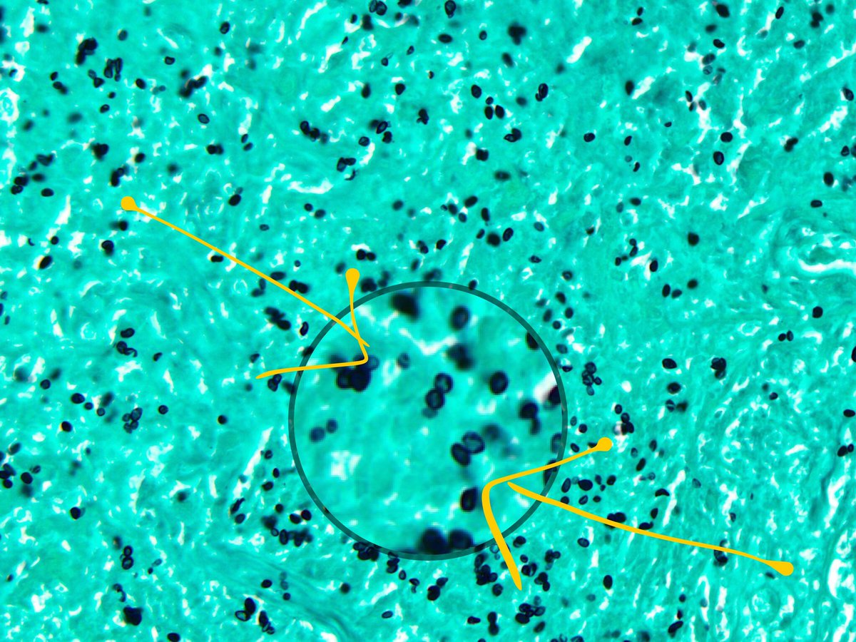 smlungpathguy's tweet image. Narrow-based budding in Histoplasma #pathology #pulmpath @AsoniDO @dr_abdulaleem @TimAllenMDJD @pembeoltulu (happens in Crypto too)