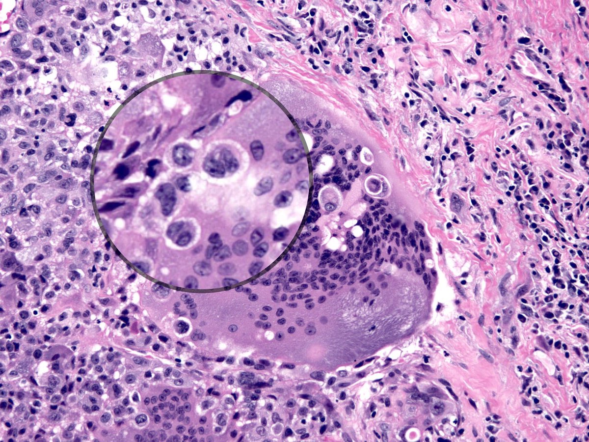 smlungpathguy's tweet image. Emperipolesis #pathology @LorDiPasquale @Missle