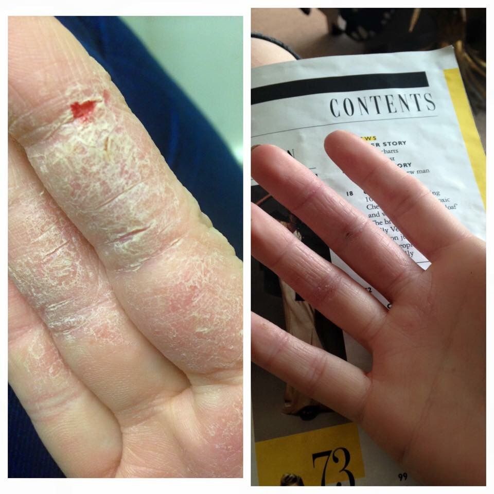 frannhall91's tweet photo. B E R R Y   P O W E R 🍇🍒

Sian's Eczema Was Sooo Bad Until She Tried Our Berries! 🍇

#berries
#ProjectHealth https://t.co/WAvdO8x5M6