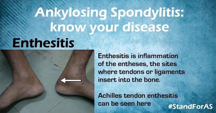 doctorakerkar's tweet image. #StandForAS #ankylosingspondylitis #spondylitis