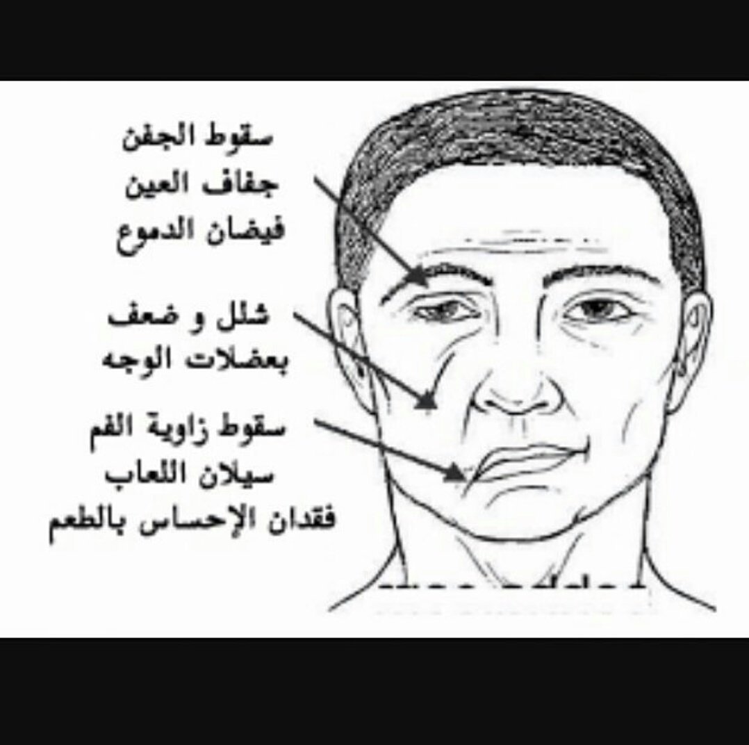 أخصائي علاج طبيعي A Twitter التهاب العصب السابع ابو وجه اعراضه وبعض التمارين المساعدة لتقوية عضلات الوجه المصابة جدة علاج طبيعي الأهلي الأتحاد الهلال Https T Co Y2zboqg5mb