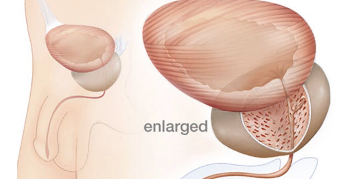drdavidsamadi's tweet photo. #Tips to help prevent an #enlargeprostate https://t.co/Bz0kWBqgyA https://t.co/ymGymzZVPt