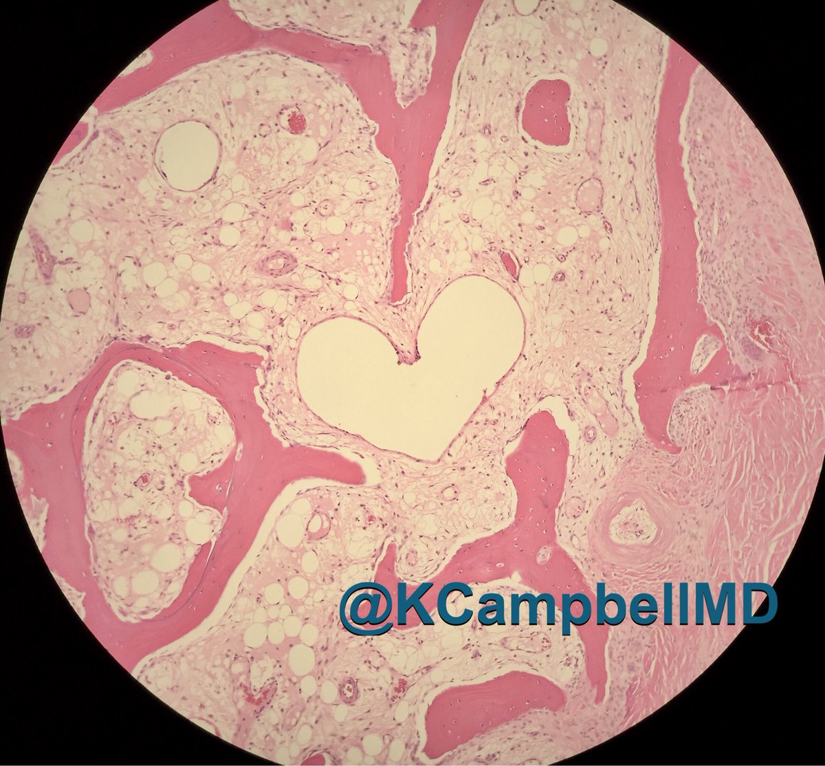 KCampbellMD's tweet photo. Happy Valentine's Day! From my osteo amputation to yours πβ€οΈ #pathvalentine #pathology #pathart #pathheart https://t.co/EVitjfWE2r