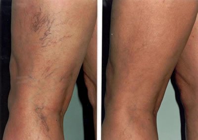 drjoannalovatt's tweet photo. Thread vein removal available now at my clinic. Call to book or to discuss your options: 01722 632633 #threadvein #Salisbury #Wiltshire https://t.co/Gn6lY2ZGgW
