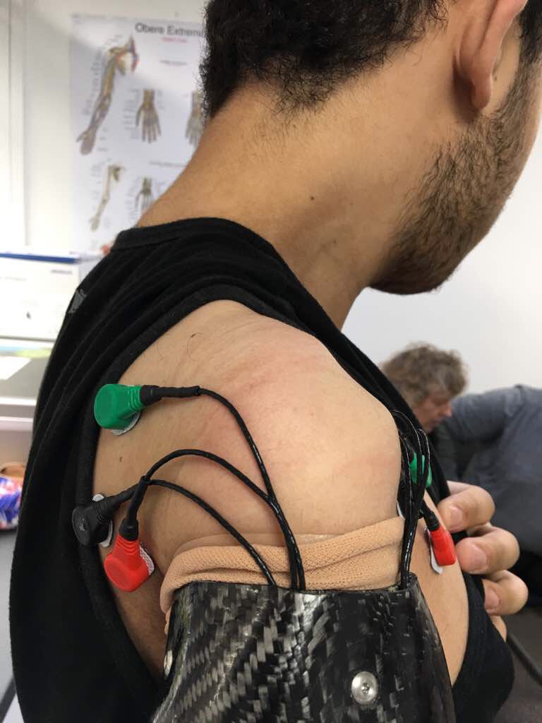 DorsetOrtho's tweet image. A fantastic a lightweight above-elbow carbon arm with a @bebionic hand using a unique control system with electrodes placed on the chest.