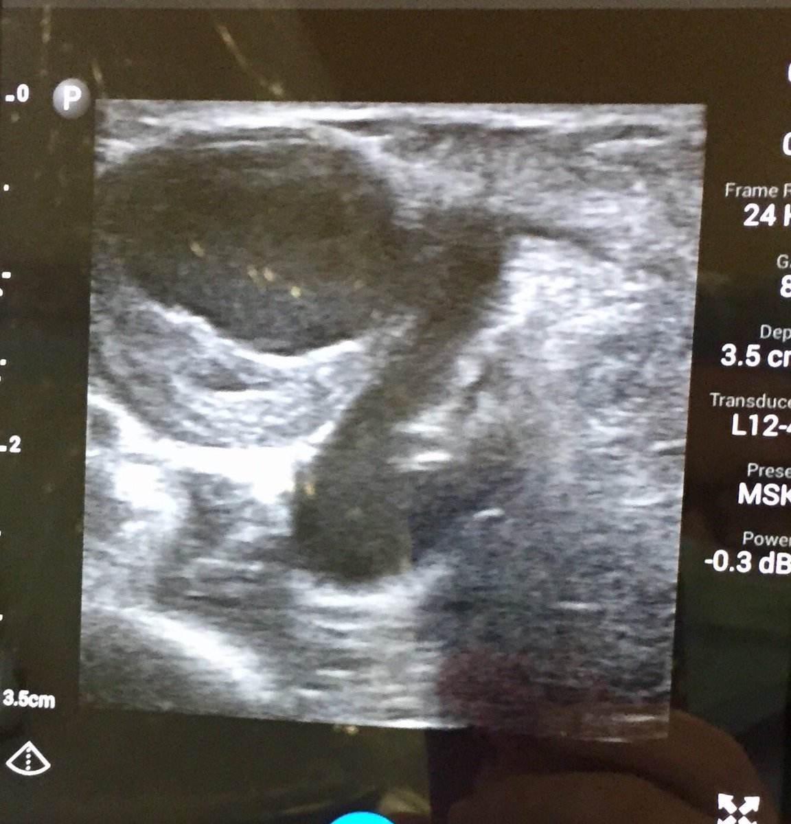 Pre and post perianastamotic PSA treated with balloon assisted Embolization under US @RPiechowiakDO #esrd #dialysis