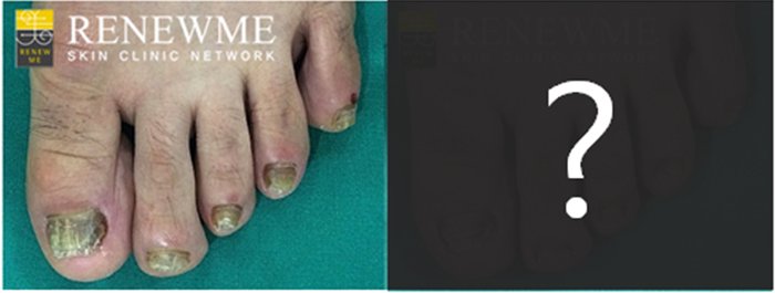 약 먹지 않는 #손발톱무좀치료 아시나요? #핀포인트레이저 로 약 복용 없이도 간단히 #발톱무좀 치료가 가능합니다! 지금부터 #발톱무좀치료 받으시고 여름철 시원하게 맨발로 물놀이 가세요! m.rnmeskin.com/clinic126/