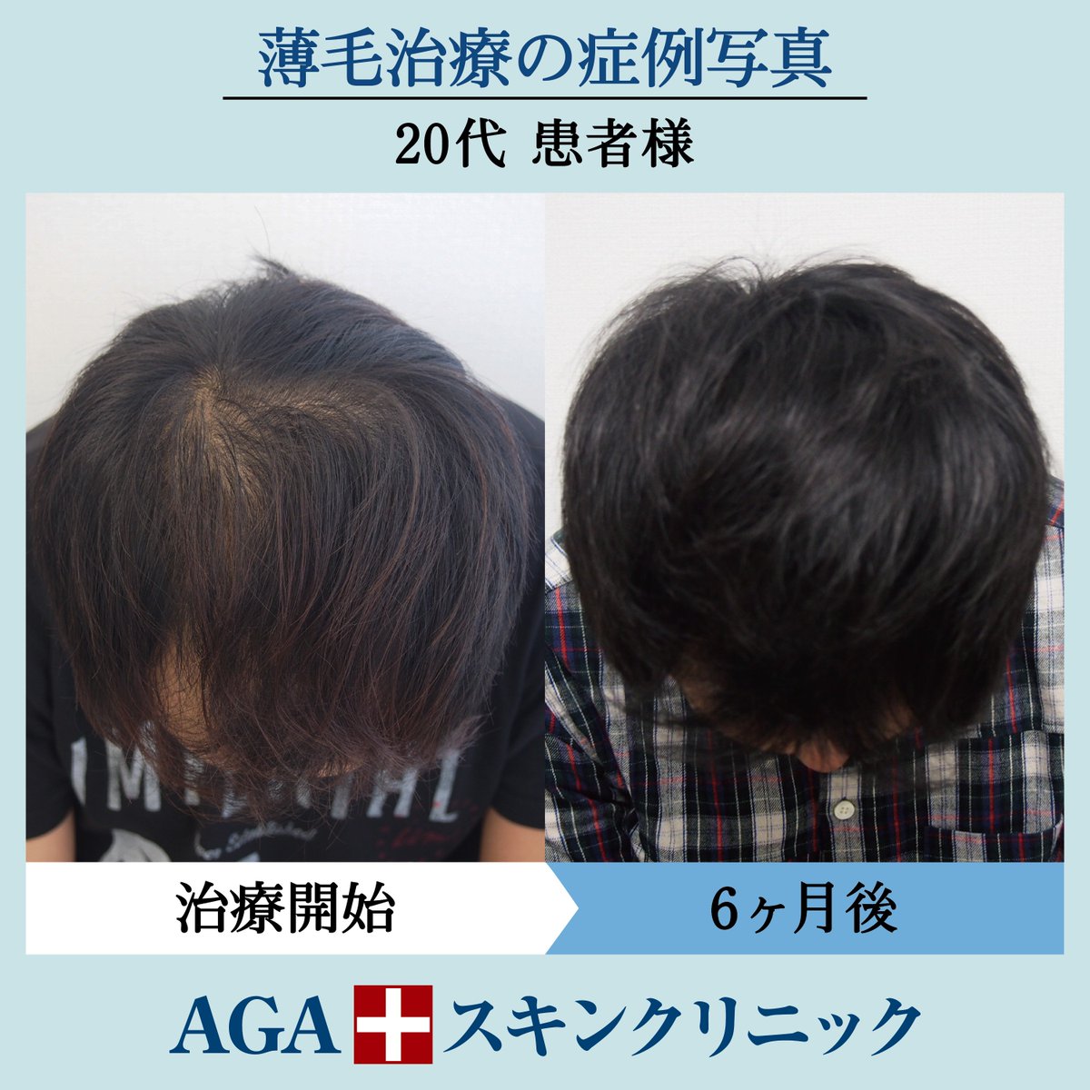 フサちゃん Agaスキンクリニック公式 On Twitter Agaスキンクリニック 難波 院で 治療 された患者さまの症例写真をご紹介 当院オリジナルの発毛薬とdr Sメソセラピーで治療を開始し 前頂部が劇的に変化しました その他の症例写真はこちら Https T Co