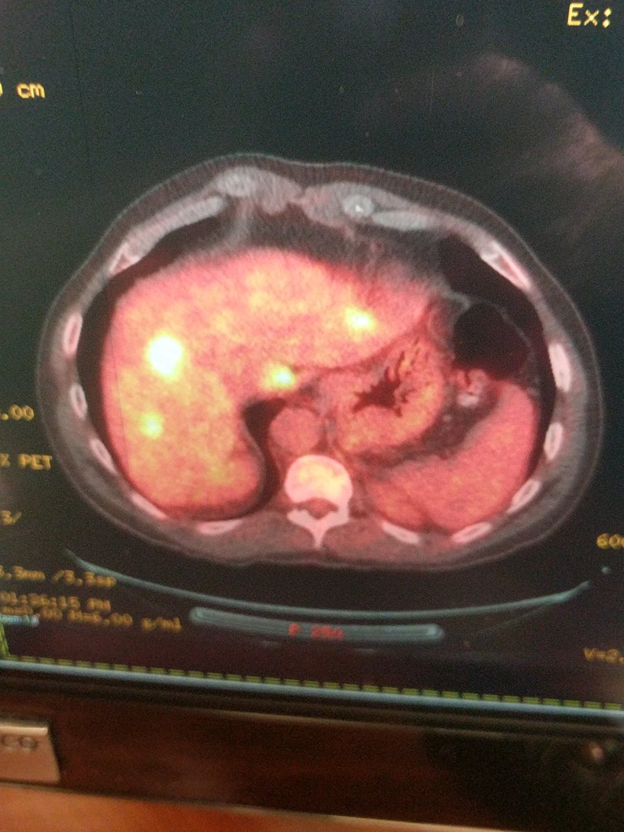 11Blade's tweet photo. Pre and post y90. Metastatic pancreatic CA. 12 months post-y90 - disease free on PET #irad #SIRsphere #io #miip #IR @sirtex https://t.co/UdCmJisLH0