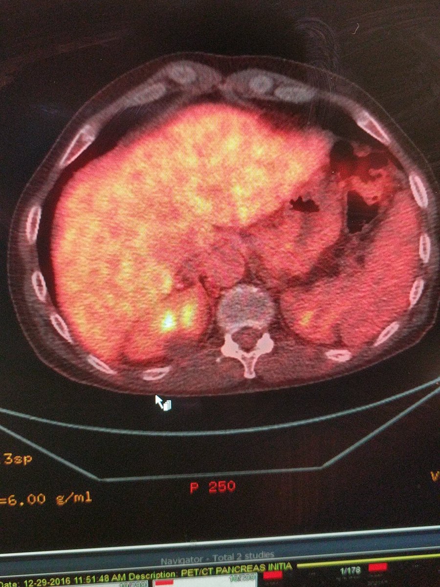 11Blade's tweet photo. Pre and post y90. Metastatic pancreatic CA. 12 months post-y90 - disease free on PET #irad #SIRsphere #io #miip #IR @sirtex https://t.co/UdCmJisLH0